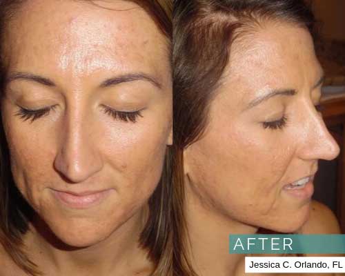 Results After image of acne treatments at TS Skin Care in Orlando
