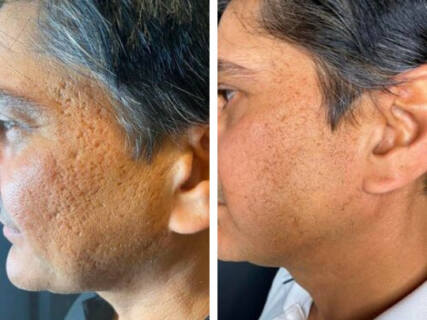 Acne scarring before and after microneedling RF