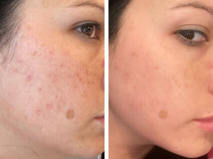 Microneedling RF before and after