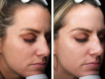 Microneedling RF before and after