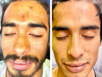 Virtue RF Scarring Before and After