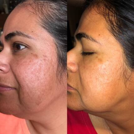 Microneedling RF before and after