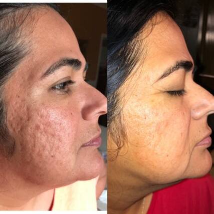 Microneedling RF before and after