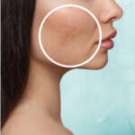 Goodbye acne scarring with mirconeedling RF