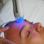 Blue light LED Virtue RF microneedling