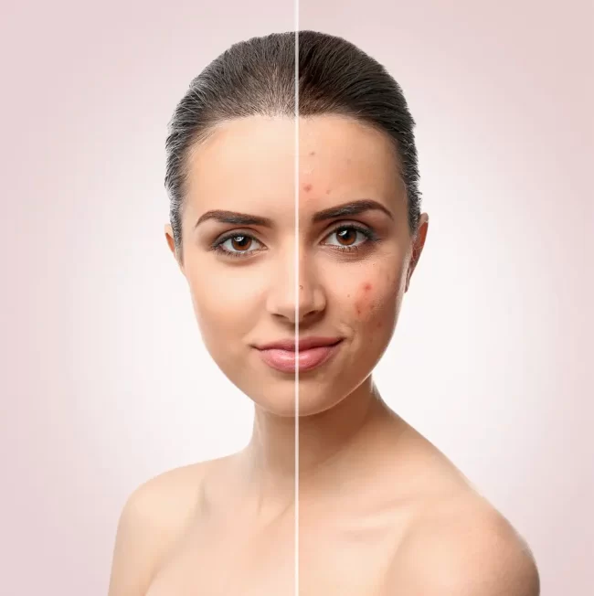 r_shutterstock_603810884 Acne treatment on a woman