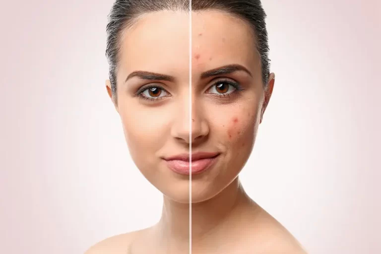 Acne treatment on a woman