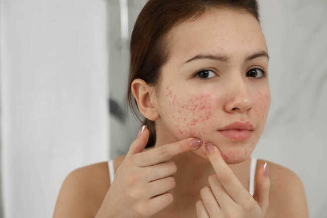 what-are-the-correlations-between-gut-health-and-acne Young women with acne looking in mirror