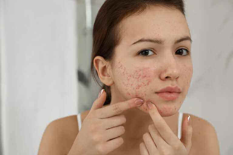 Young women with acne looking in mirror