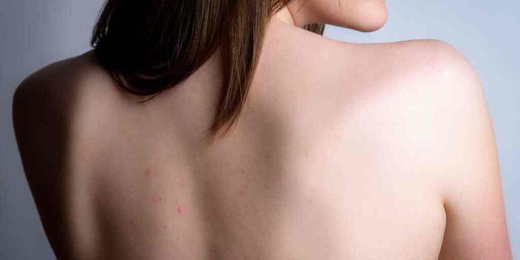 Female,Back,With,Acne,,Red,Spots,,Pimples.,Young,Girl,With Acne on back