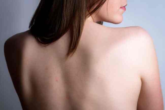 Female,Back,With,Acne,,Red,Spots,,Pimples.,Young,Girl,With Acne on back