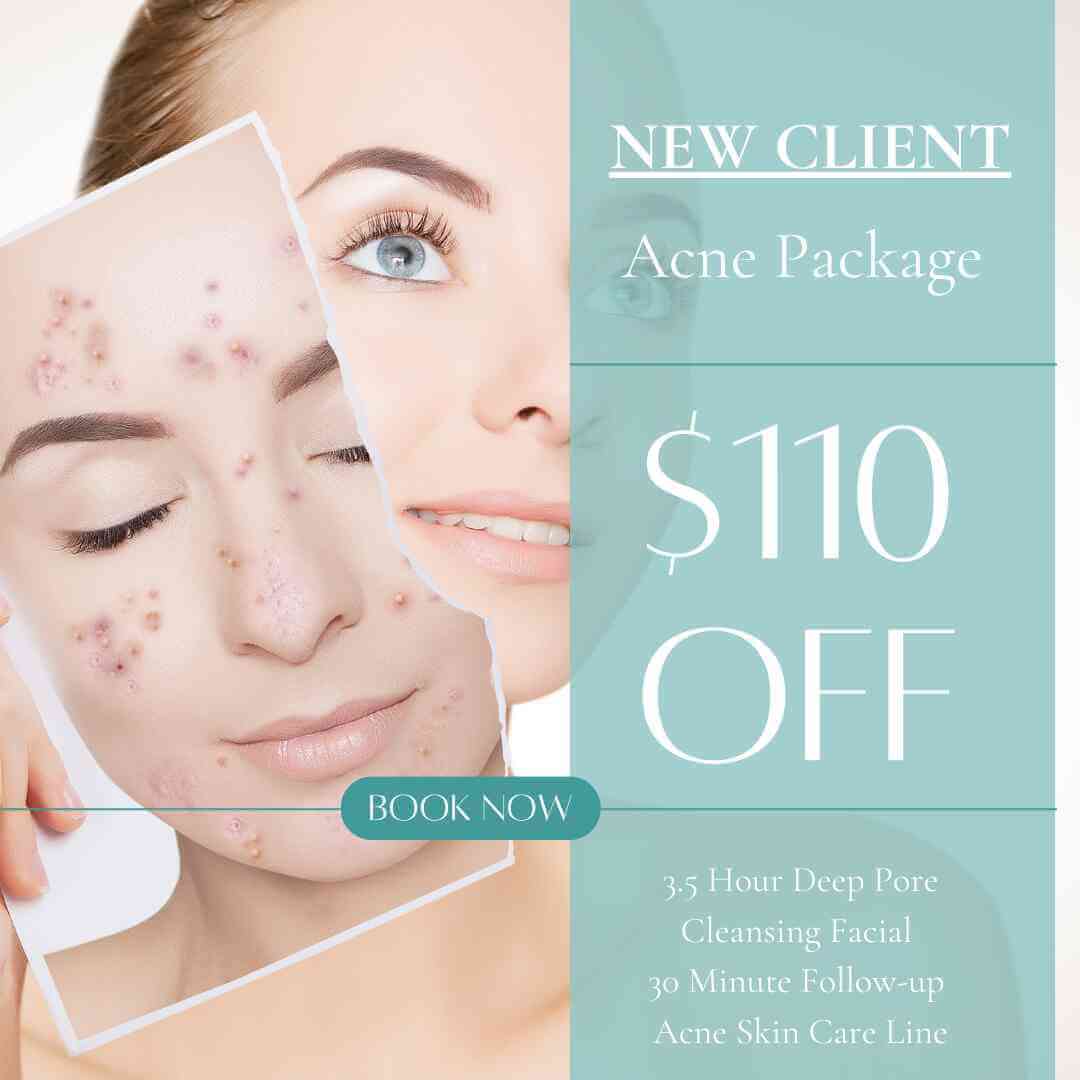 20% off of New Client Acne Package
